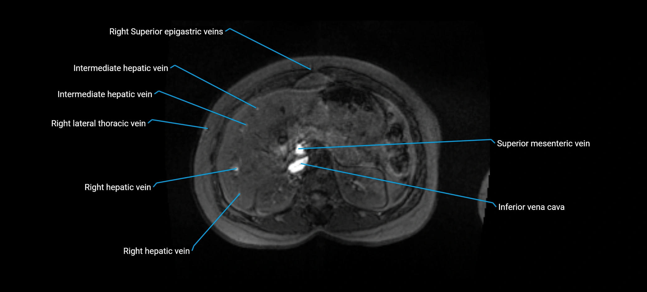 MRV abdomen pelvis & lower limb axial cross sectional anatomy labelled MRI image 53 (1).webp